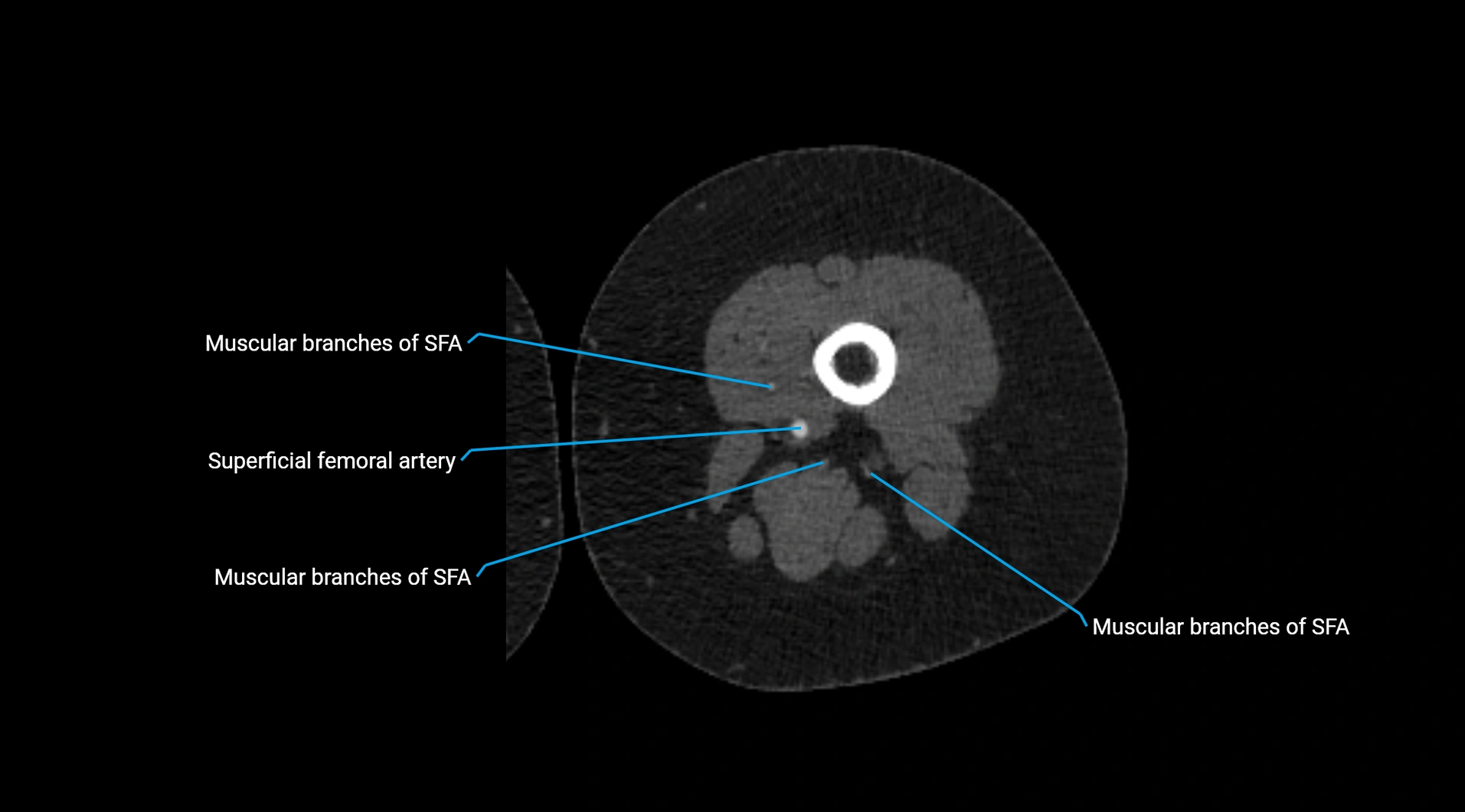 CTA lower limb cross sectional anatomy labelled image _142.webp